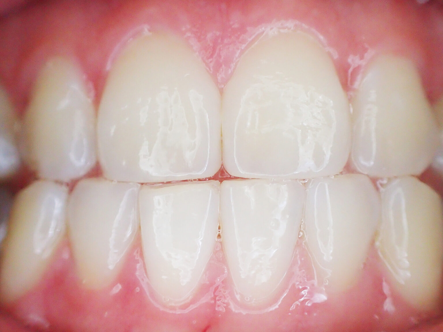 teeth translucent cracking