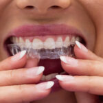 5 Popular Reasons To Consider Invisalign