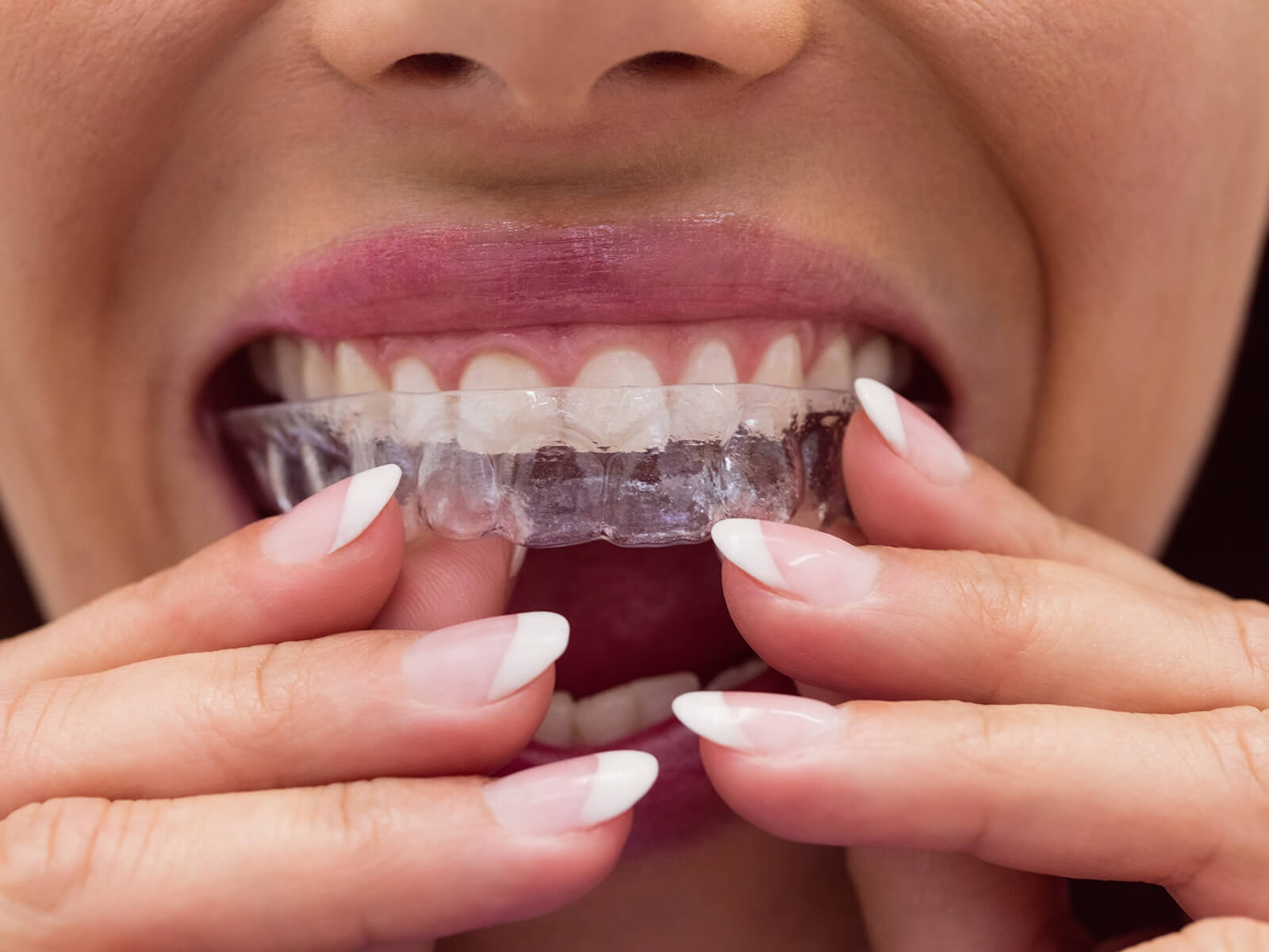 5 Popular Reasons To Consider Invisalign