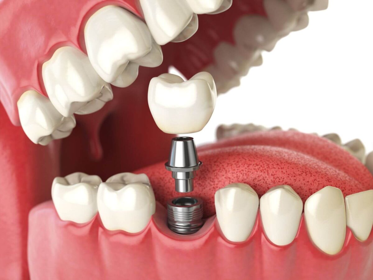 How Do I Know If I Need Dental Implants?