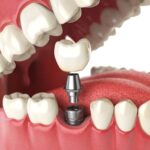 How Do I Know If I Need Dental Implants?