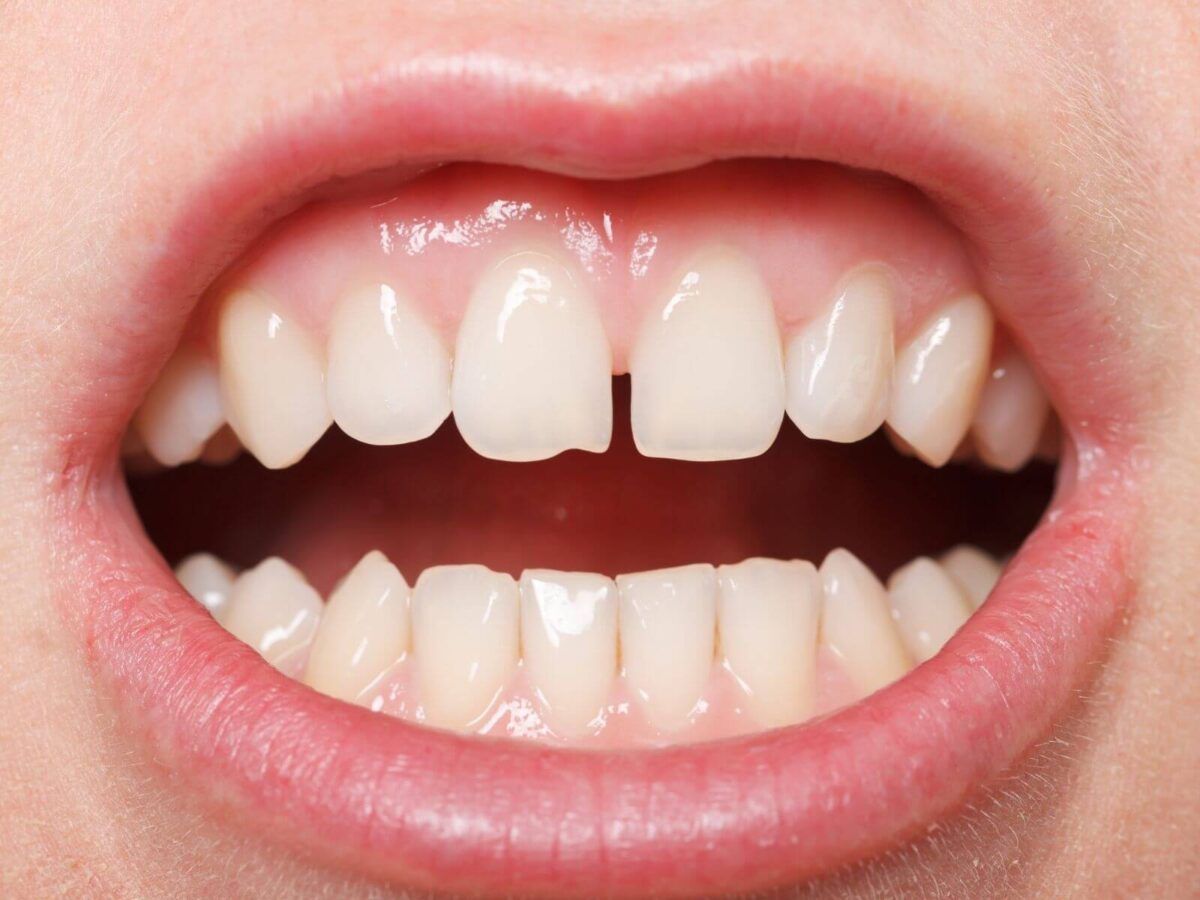 How To Recognize Signs of Gum Recession?